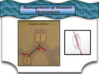 Management of MassiveManagement of Massive
HemoptysisHemoptysis
 