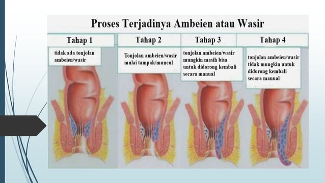 hemoroid-pptx