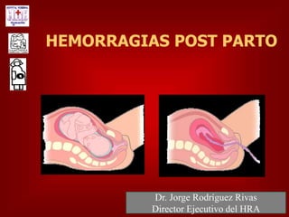 HEMORRAGIAS POST PARTO
Dr. Jorge Rodríguez Rivas
Director Ejecutivo del HRA
 