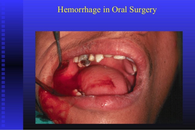 Oral Hemorrhage 72