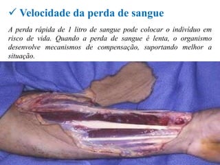  Velocidade da perda de sangue
A perda rápida de 1 litro de sangue pode colocar o indivíduo em
risco de vida. Quando a perda de sangue é lenta, o organismo
desenvolve mecanismos de compensação, suportando melhor a
situação.
 
