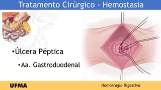 Tratamento Cirúrgico - Hemostasia
•Úlcera Péptica
•Aa. Gastroduodenal
Hemorragia Digestiva
 