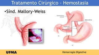 Tratamento Cirúrgico - Hemostasia
•Sínd. Mallory-Weiss
Hemorragia Digestiva
 