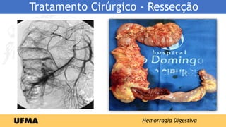 Tratamento Cirúrgico - Ressecção
•Vasculopatias
•Angiodisplasia
Hemorragia Digestiva
 