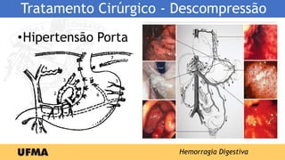 Tratamento Cirúrgico - Descompressão
•Hipertensão Porta
Hemorragia Digestiva
 