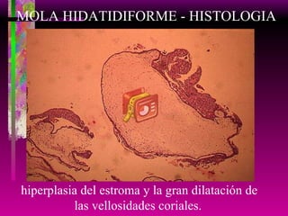 MOLA HIDATIDIFORME - HISTOLOGIA hiperplasia del estroma y la gran dilatación de las vellosidades coriales.   