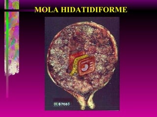 MOLA HIDATIDIFORME 