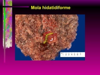 Mola hidatidiforme 