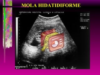 MOLA HIDATIDIFORME 