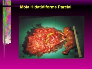 Mola Hidatidiforme Parcial 