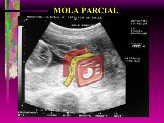 MOLA PARCIAL 