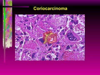 Coriocarcinoma 