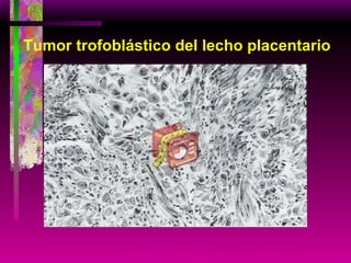 Tumor trofoblástico del lecho placentario Arato G et al. Pathology Oncology Research 2000;6;4:292 