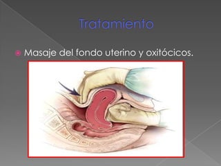 Tratamiento <br />Masaje del fondo uterino y oxitócicos.<br />