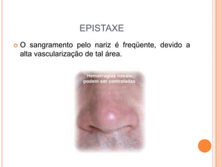 EPISTAXE
 O sangramento pelo nariz é freqüente, devido a
alta vascularização de tal área.
 