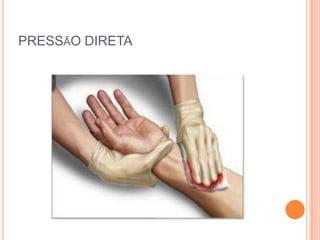 PRESSÃO DIRETA
 