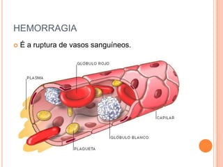 HEMORRAGIA
 É a ruptura de vasos sanguíneos.
 