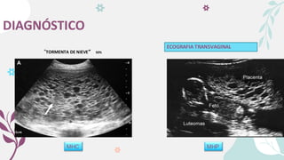 DIAGNÓSTICO
MHC MHP
ECOGRAFIA TRANSVAGINAL
“TORMENTA DE NIEVE” 50%
 