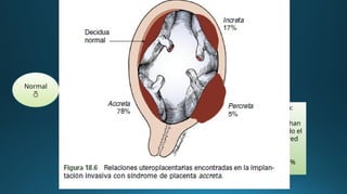 Placenta acreta:
Se caracteriza por
que las
vellosidades se
encuentran
adheridas al
miometrio (sin
invadirlo), es el
80% del espectro.
Placenta increta:
Aquí las
vellosidades de la
placenta ya
invaden el
miometrio,
corresponde al
15% del espectro.
Placenta percreta:
Las vellosidades han
penetrado en todo el
espesor de la pared
uterina, llegando
hasta la serosa.
Corresponde al 5%
del espectro.
Normal

 