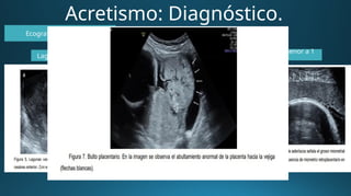 Acretismo: Diagnóstico.
Ecografía con Doppler.
Lagunas vasculares placentarias
Interfase miometrial menor a 1
mm
 
