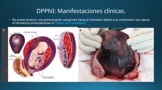 • Se puede producir una extravasación sanguínea hacia el miometrio debido a la compresión que ejerce
el hematoma produciéndose un "útero de Couvelaire".
DPPNI: Manifestaciones clínicas.
 