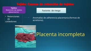Tejido: Causas de retención de tejidos
• Retenciones
de
cotiledones
Factores de riesgo
Anomalías de adherencia placentaria (formas de
acretismo).
Placenta incompleta
Tejidos:
Retención de tejidos
placentarios.
 
