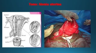 Tono: Atonía uterina
 