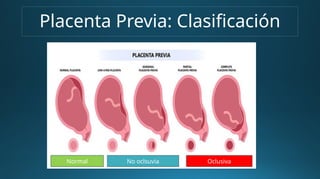 Placenta Previa: Clasificación
No oclsuvia Oclusiva
Normal
 