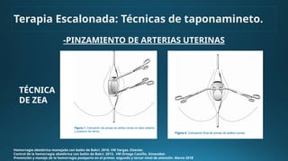 -PINZAMIENTO DE ARTERIAS UTERINAS
Hemorragia obstétrica manejada con balón de Bakri. 2016. VM Vargas. Elsevier.
Control de la hemorragia obstétrica con balón de Bakri. 2013. VM Ortega Castillo. Ginecobst.
Prevención y manejo de la hemorragia postparto en el primer, segundo y tercer nivel de atención. Marzo 2018
TÉCNICA
DE ZEA
Terapia Escalonada: Técnicas de taponamineto.
 