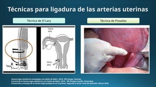 Técnicas para ligadura de las arterias uterinas
Hemorragia obstétrica manejada con balón de Bakri. 2016. VM Vargas. Elsevier.
Control de la hemorragia obstétrica con balón de Bakri. 2013. VM Ortega Castillo. Ginecobst.
Prevención y manejo de la hemorragia postparto en el primer, segundo y tercer nivel de atención. Marzo 2018
Técnica de O´Lary Técnica de Posadas
 