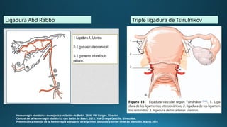 Hemorragia obstétrica manejada con balón de Bakri. 2016. VM Vargas. Elsevier.
Control de la hemorragia obstétrica con balón de Bakri. 2013. VM Ortega Castillo. Ginecobst.
Prevención y manejo de la hemorragia postparto en el primer, segundo y tercer nivel de atención. Marzo 2018
Triple ligadura de Tsirulnikov
Ligadura Abd Rabbo
 