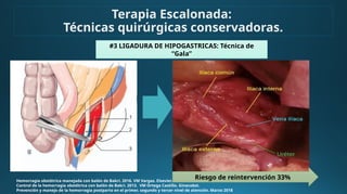 Hemorragia obstétrica manejada con balón de Bakri. 2016. VM Vargas. Elsevier.
Control de la hemorragia obstétrica con balón de Bakri. 2013. VM Ortega Castillo. Ginecobst.
Prevención y manejo de la hemorragia postparto en el primer, segundo y tercer nivel de atención. Marzo 2018
#3 LIGADURA DE HIPOGASTRICAS: Técnica de
“Gala”
Riesgo de reintervención 33%
Terapia Escalonada:
Técnicas quirúrgicas conservadoras.
 