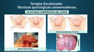 Hemorragia obstétrica manejada con balón de Bakri. 2016. VM Vargas. Elsevier.
Control de la hemorragia obstétrica con balón de Bakri. 2013. VM Ortega Castillo. Ginecobst.
Prevención y manejo de la hemorragia postparto en el primer, segundo y tercer nivel de atención. Marzo 2018
#2 SUTURAS COMPRESIVAS DEL UTERO
Terapia Escalonada:
Técnicas quirúrgicas conservadoras.
Puntos transfictivos “Ho-Cho”
Técnica de B-Lynch
Hayman
 