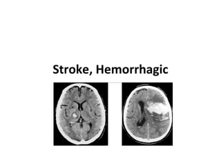 Stroke, Hemorrhagic 
