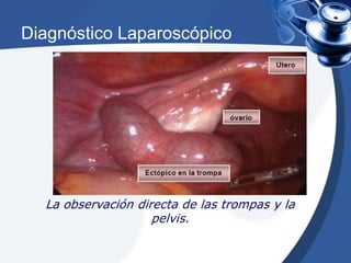 Diagnóstico Laparoscópico 
La observación directa de las trompas y la 
pelvis. 
 