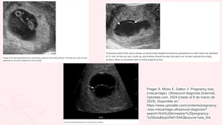 Prager S, Micks E, Dalton V. Pregnancy loss
(miscarriage): Ultrasound diagnosis [Internet].
Uptodate.com. 2024 [citado el 8 de marzo de
2025]. Disponible en:
https://www.uptodate.com/contents/pregnancy
-loss-miscarriage-ultrasound-diagnosis?
search=first%20trimestrer%20pregnancy
%20loss&topicRef=5442&source=see_link
 