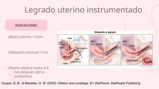 Legrado uterino instrumentado
Altura uterina >12cm
Dilatación cervical >1cm
Aborto séptico hasta 6-8
hrs después del tx
antibiótico
INDICACIONES
Cooper, D. B., & Menefee, G. W. (2025). Dilation and curettage. En StatPearls. StatPearls Publishing
 