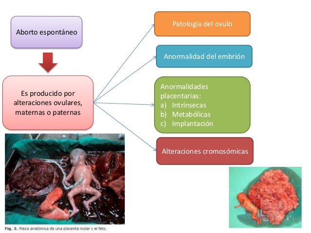 Hemorragia Del Primer Trimestre Del Embarazo