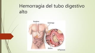 Hemorragia del tubo digestivo
alto
 