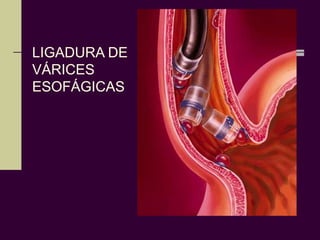 LIGADURA DE
VÁRICES
ESOFÁGICAS
 