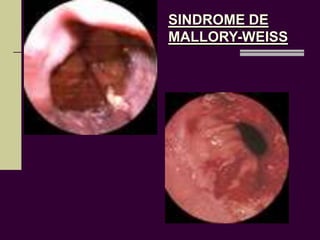 SINDROME DE
MALLORY-WEISS
 