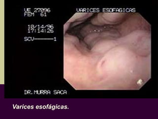 Varices esofágicas.
 