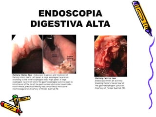 ENDOSCOPIA
DIGESTIVA ALTA
 