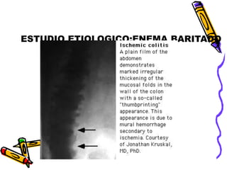 ESTUDIO ETIOLOGICO:ENEMA BARITADO
 