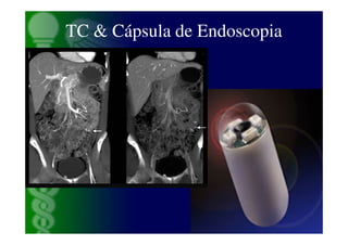 TC & Cápsula de Endoscopia
 