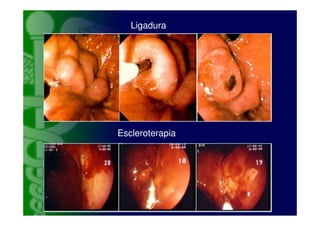Ligadura




Escleroterapia
 