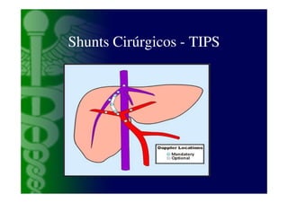 Shunts Cirúrgicos - TIPS
 