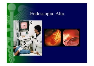 Endoscopia Alta
 