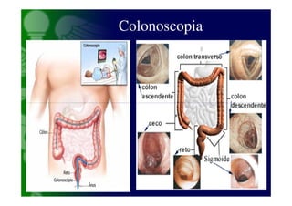 Colonoscopia
 
