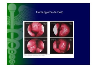 Hemangioma de Reto
 